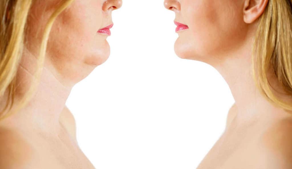 Double Chin treatment Essex before and after results