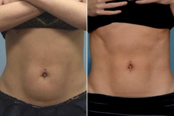 body sculpting FAQs Essex