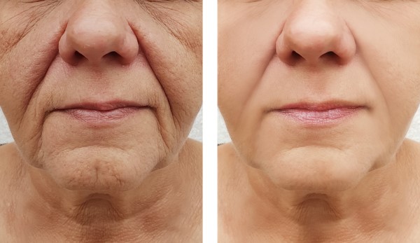 Learn more about Morpheus8 Treatment Essex today!