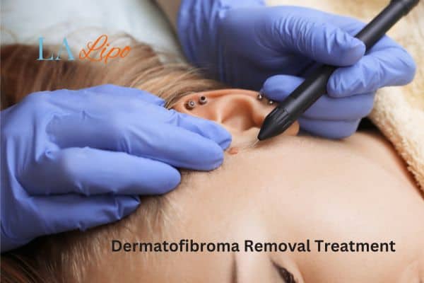 Dermatofibroma Removal Treatment Essex