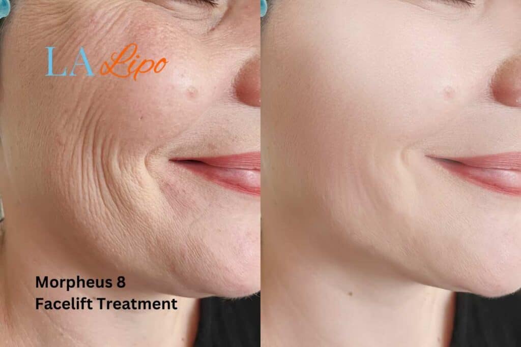 Morpheus8 Treatment Essex for flawless skin! Call us today!