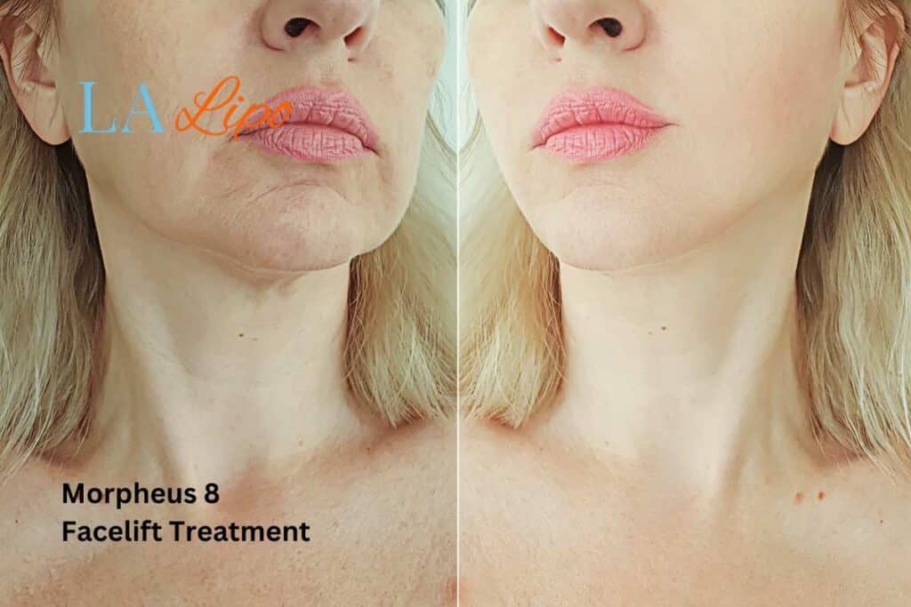 Turn back time with Morpheus8 Treatment Essex