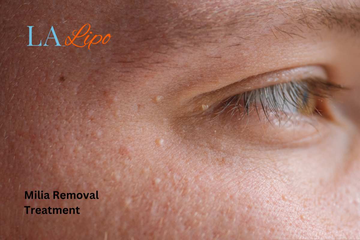 Cryopen Milia Removal: Is It the Easiest and Safest Option Essex?