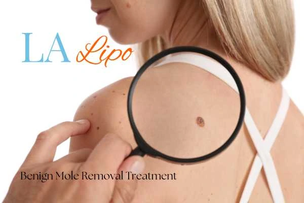 Why getting moles removed Essex can boost your confidence!