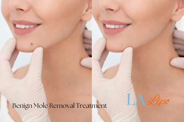 Woman's before and after results of being moles removal treatment Essex