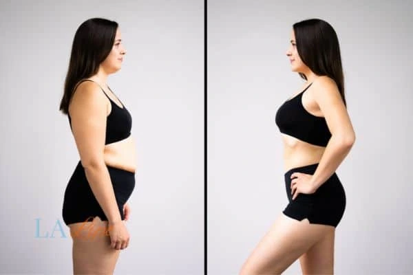 image of woman before and after results of LA-EMS Body Sculpting Essex to help treat Diastasis recti
