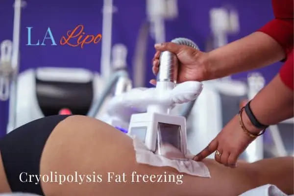 women getting fat freezing Essex