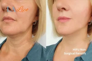 hi-fu for wrinkles Essex before and after results