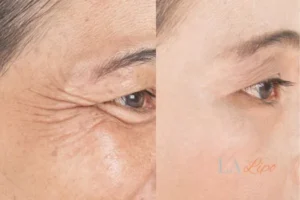 Before and after results of woman - HI-fu wrinkles reduction treatment Essex
