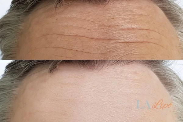 results of HIFU Essex on mans forehead to help reduce lines and wrinkles