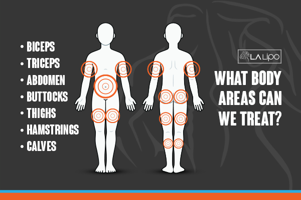 Graphic to show areas you can have LA-EMS Body Sculpting Essex treatment.