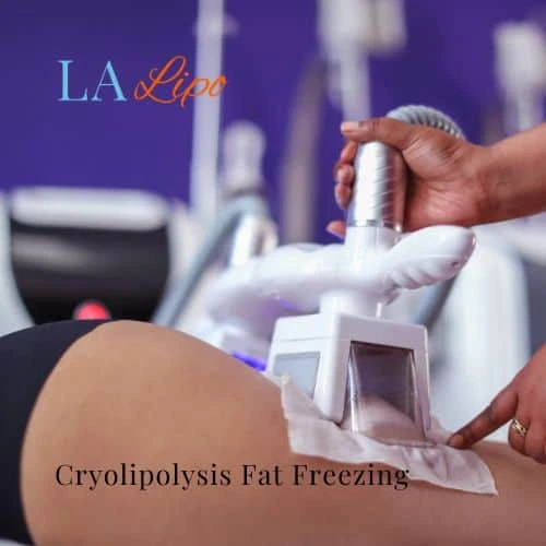 fat freezing - Cryolipolysis Essex