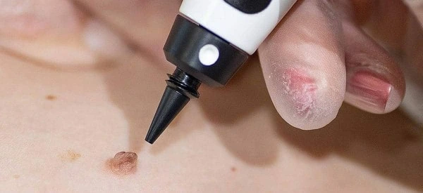 skin tag removal using cryopen Essex