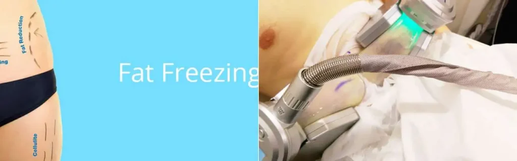 Fat freezing Essex on multiple areas of the body