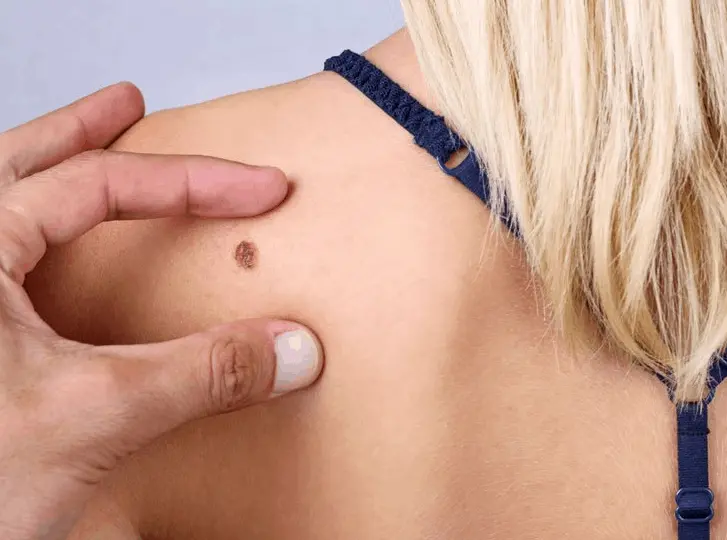 woman having mole removal Essex consultation before treatment.