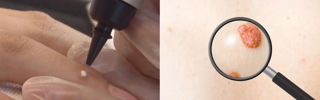 Person getting moles removed with cryopen Essex