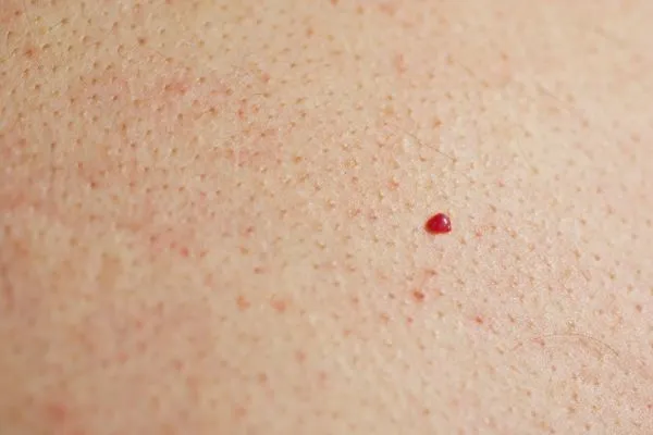 close up of a cherry angioma Essex
