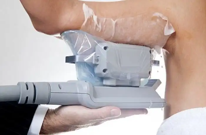 Picture of fat freezing Essex on the upper arms.