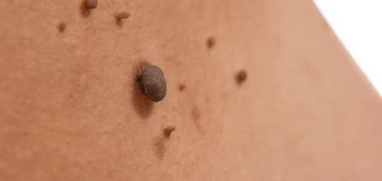 image of a skin tag Essex