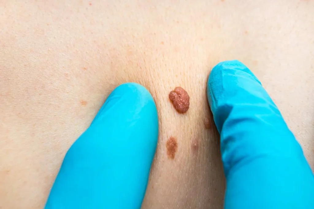 Consultant examining a skin tag Essex