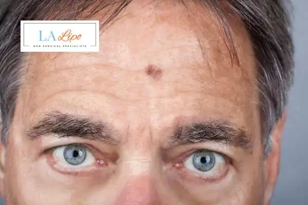 Solar Lentigo Removal Essex image of man with mark on his forehead