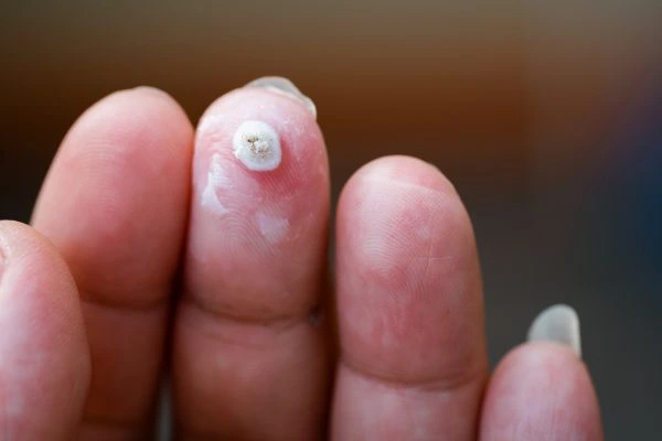 wart on person finger - cryotherapy to treat from LA LIPO Essex