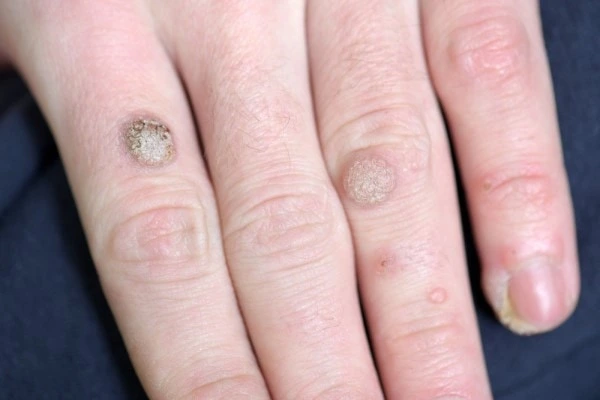 photo of warts on person hand - see wart removal Essex from LA LIPO