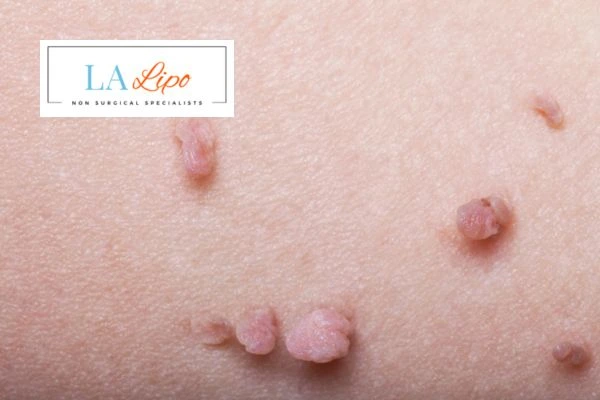 Does cryopen skin tag removal Essex hurt? Find out now call our team today!