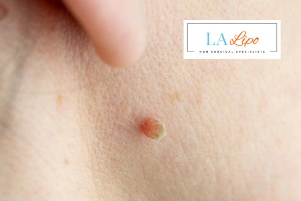 Book skin tag removal Essex today speak to our team now!