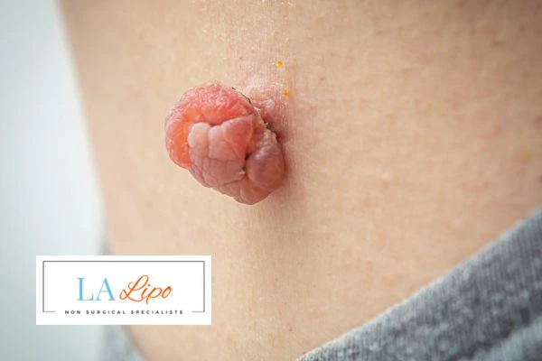Interested in skin tag removal Essex? Concerned about the pain? Find out more today!