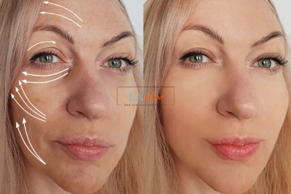 Morpheus 8 results Essex face lift.