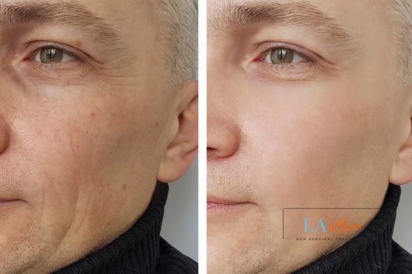 See the amazing results of Morpheus8 Treatment Essex!