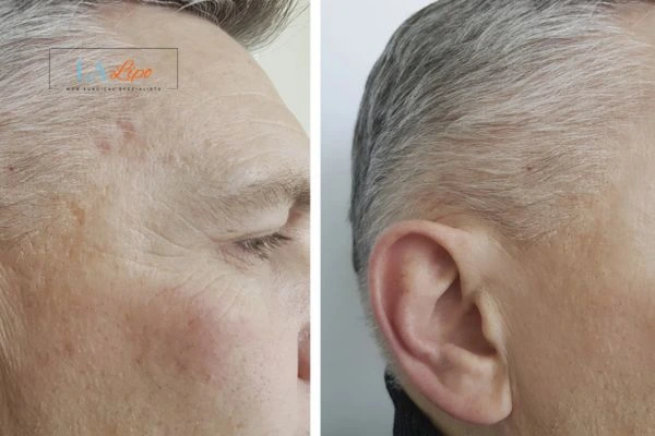 Mens Before & After Morpheus 8 Results Essex