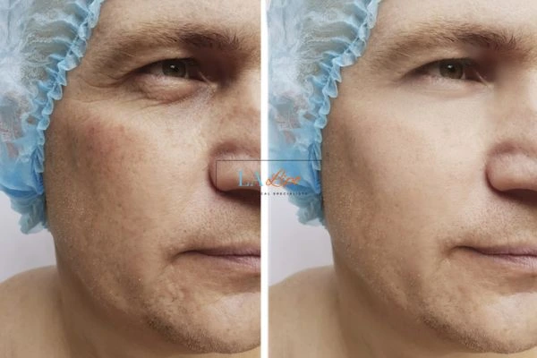 Before and after Morpheus 8 Results Essex