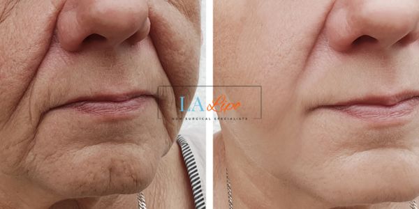 Older lady deeper wrinkle reduction - LA LIPO Morpheus 8 Results Essex