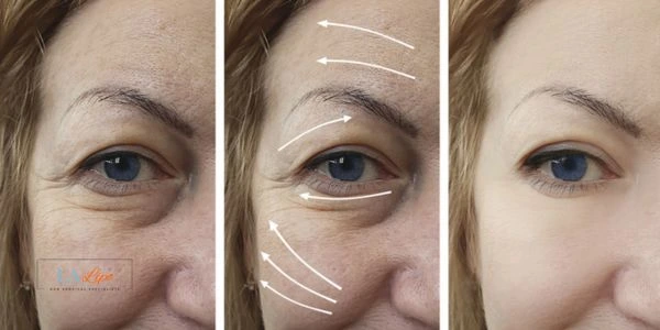Amazing eye lift Morpheus 8 results Essex