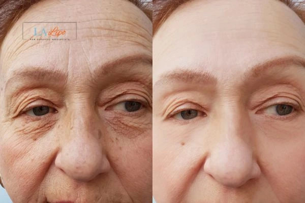 The powerful benefits of Morpheus8 Treatment Essex - Call Our team today!