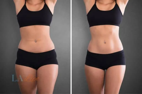 before and after results of non-surgical treatment to help a woman's body image and mental health Essex