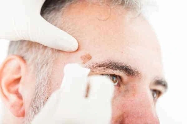Age spots and elderly people Essex what is the link?