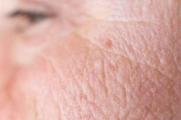 close up picture of a woman's face showing an age spot Essex