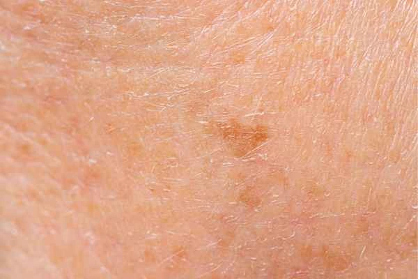 close up picture of age spots Essex