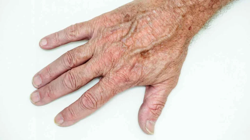 Male hand showing age spot Essex