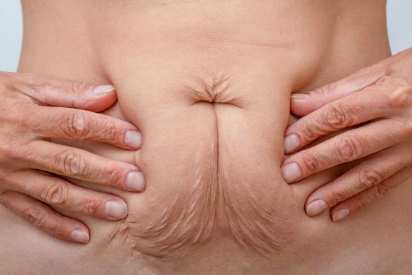 Image of a woman's stomach with loose skin - example of skin tightening Essex options