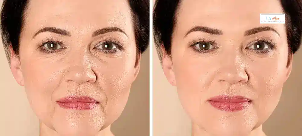 How Long Does It Take to See Results and How Long Do They Last Essex?
