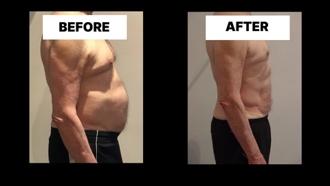 What Symptoms Can Diastasis Recti Cause in Men? Weak Core, Back Pain and Poor Posture Essex